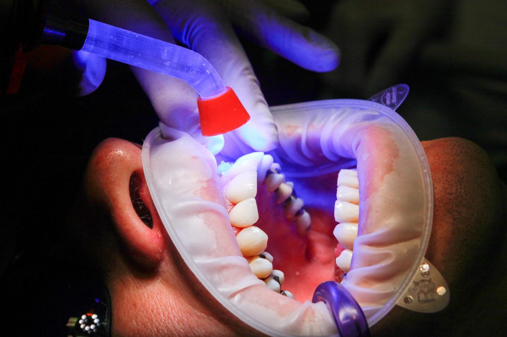 odbudowa zębów po leczeniu kanałowym