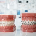 porównanie metod leczenia: zalety aparatów nakładkowych - zdjęcie