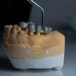 przykład zakładania korony na zęby - zdjęcie