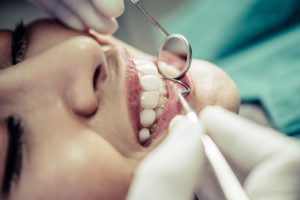Dentysta wykonuje zabieg odbudowy zęba w Krakowie, przy użyciu narzędzi dentystycznych do precyzyjnego leczenia