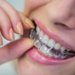 Kobieta z różowym manikiurem zakłada dolną, przezroczystą nakładkę Invisalign Batowice na zęby, ukazując ich dopasowanie i dyskrecję.